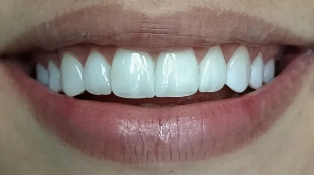 Facetas de Resina Composta